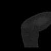 SPORK, NICO - 22.03.1976 - 02.08.2022 - CT obere Extremität - 17:59:07